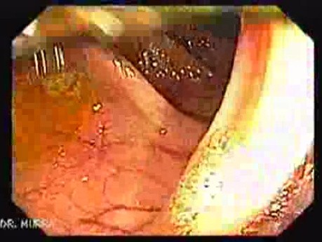 Colonoscopy