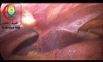 Adhesions Between the Fused Liver Lobes and Anterior Abdominal Wall