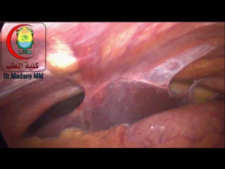 Adhesions Between the Fused Liver Lobes and Anterior Abdominal Wall