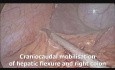 Laparoscopic Total Proctocolectomy with Ileal Pouch Anal Anastomosis (IPAA)