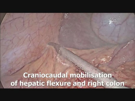 Laparoscopic Total Proctocolectomy with Ileal Pouch Anal Anastomosis (IPAA)