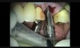 Periodontal Microsurgery: Immediate Maxillary Molar Implant