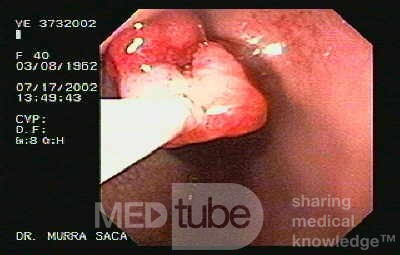 Polypectomy (3 of 6)