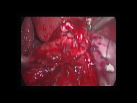 Bladder Endometriosis