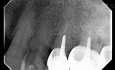 Calcified Premolar with Vertucci Type VI (2-1-2)