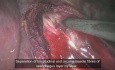 Laparoscopic excision of Giant Oesophageal Leiomyoma 