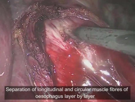 Laparoscopic excision of Giant Oesophageal Leiomyoma 