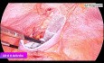 Laparoscopic Management of Suprapubic Incisional Hernia
