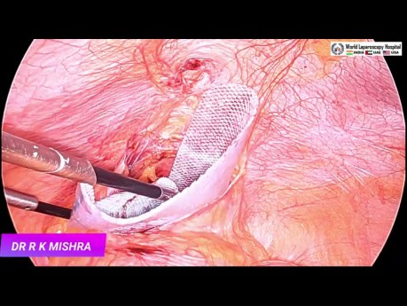 Laparoscopic Management of Suprapubic Incisional Hernia