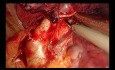 Uniportal VATS Trisegmentectomy (Non Edited Surgery)