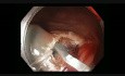 IC valve - Large Flat Lesion - EMR - Bleeding
