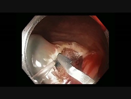 IC valve - Large Flat Lesion - EMR - Bleeding
