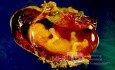 Advanced Tubal Ectopic Pregnancy