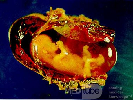 Advanced Tubal Ectopic Pregnancy