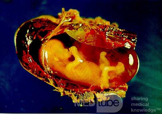 Advanced Tubal Ectopic Pregnancy