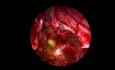 Sphenoid Sinus CSF Leak - Intrathecal Fluorescein