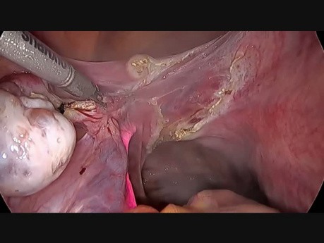 TLH with Ureter Stenting in Nellore