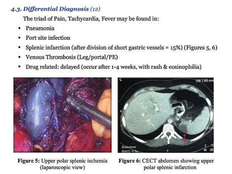 Chapter Post Sleeve Gastrectomy Leak (version 3)