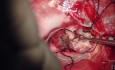 Trigonal Tumor Surgery