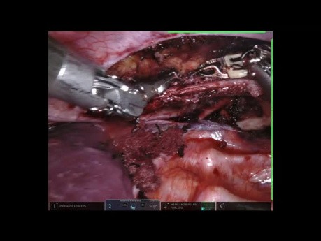 First Rib Resection to Treat Thoracic Outlet Syndrome