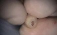 Lower Left Premolar Implant Microsurgery