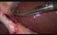 Standard Laparoscopic Cholecystectomy