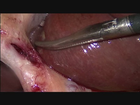 Standard Laparoscopic Cholecystectomy