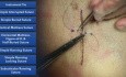 Vertical Mattress Suture - Suture Techniques