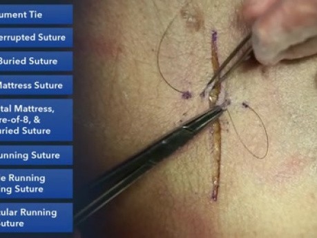 Vertical Mattress Suture - Suture Techniques