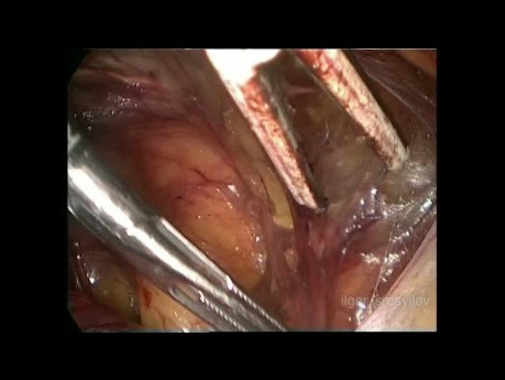 Laparoscopic TEP Repair for Bladder Hernia
