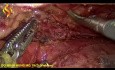 Thoraco-Laparoscopic esophagectomy - Thoracic Part 4