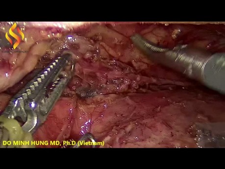 Thoraco-Laparoscopic esophagectomy - Thoracic Part 4