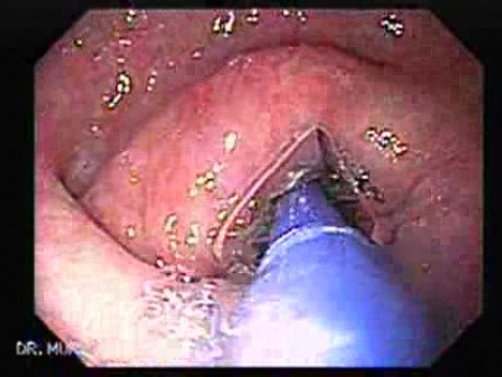 Achalasia - Guidewire For Esophageal Dilation - 3/4