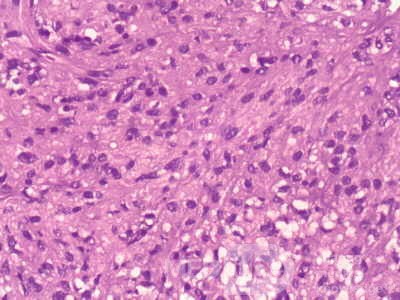 Gastrointestinal Stromal tumor (GIST) (58 of 65)