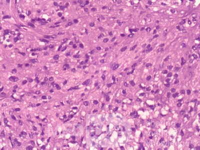 Gastrointestinal Stromal tumor (GIST) (58 of 65)