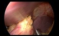 Nissen Surgery - Focus on the Dissection and Mobilisation