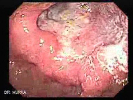 Reflux Esophagitis and Adenocarcinoma of the Antrum (2 of 3)