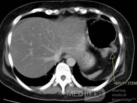 Multiple Rectal Ulcers (40 of 110)