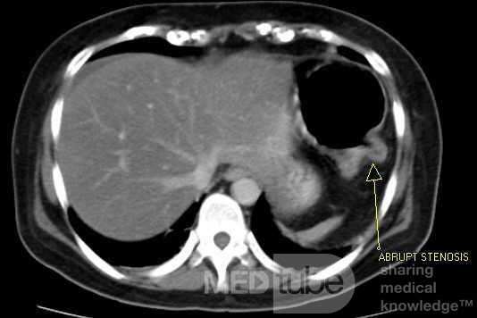 Multiple Rectal Ulcers (40 of 110)