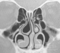 Normal Vasodilatation Of The Inferior Turbinates [CT scan]'s