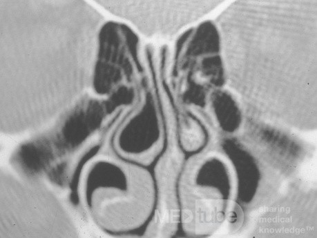 Normal Vasodilatation Of The Inferior Turbinates [CT scan]'s
