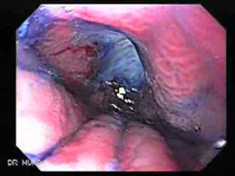 Hourglass Stomach - Assessment of the Lesions