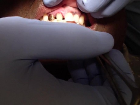 Gold Anterior Crown Occlusion Check