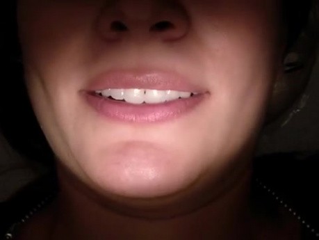 Apical Molar Surgery - Patient Perspective