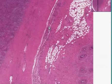Orchitis and epididymitis