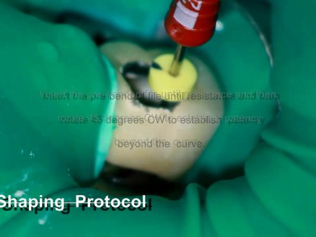 Extreme root canal anatomy - how to deal with