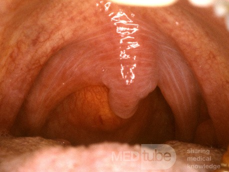 Retropharyngeal Abscess
