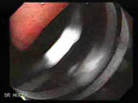 Endoscopic Presentation of Hourglass Stomach, Part 2