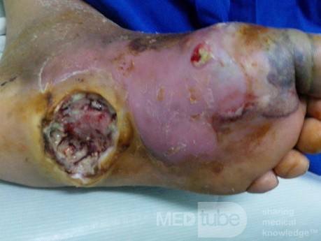 Diabetic Foot Ulcer with Sepsis