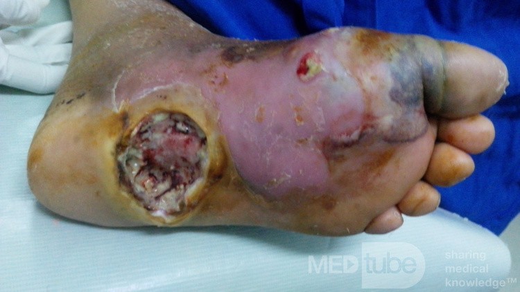 Diabetic Foot Ulcer with Sepsis